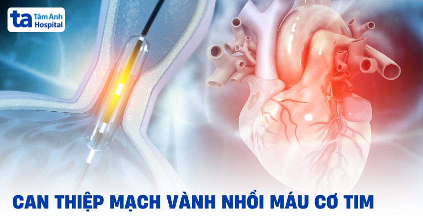 Can thiệp mạch vành cho người nhồi máu cơ tim: Chỉ định, quy trình