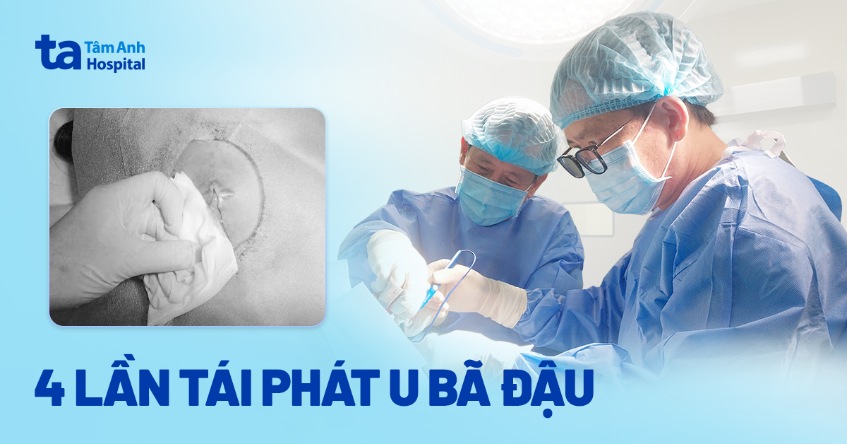 4 lần tái phát u bã đậu