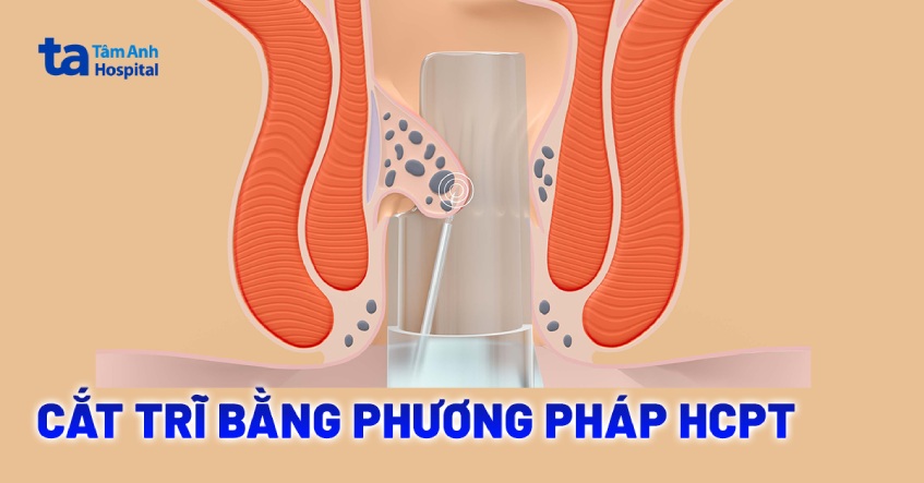 Cắt trĩ bằng phương pháp HCPT: Ưu, nhược điểm và quy trình