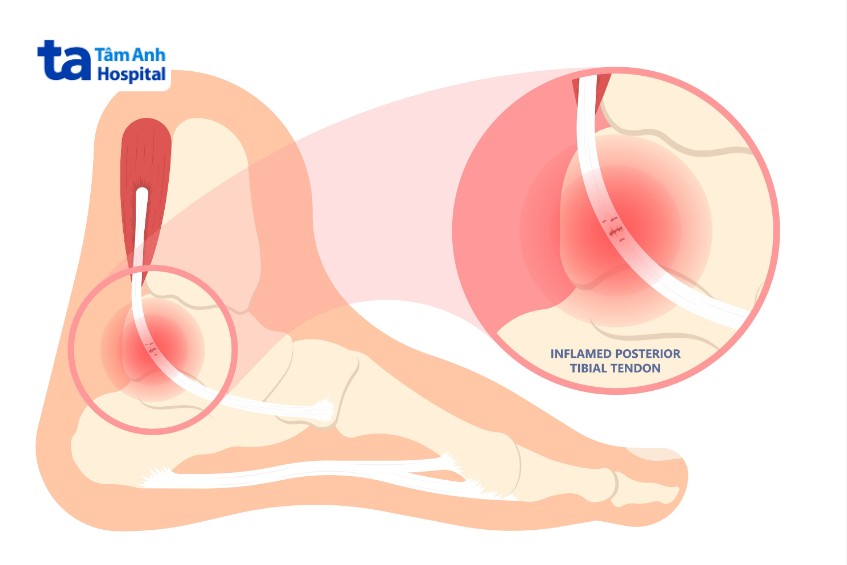 chấn thương gây viêm gân chày sau
