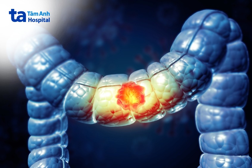 chỉ định mổ điều trị ung thư đại tràng