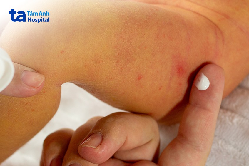 chiếu đèn vàng da có thể bị kích ứng da
