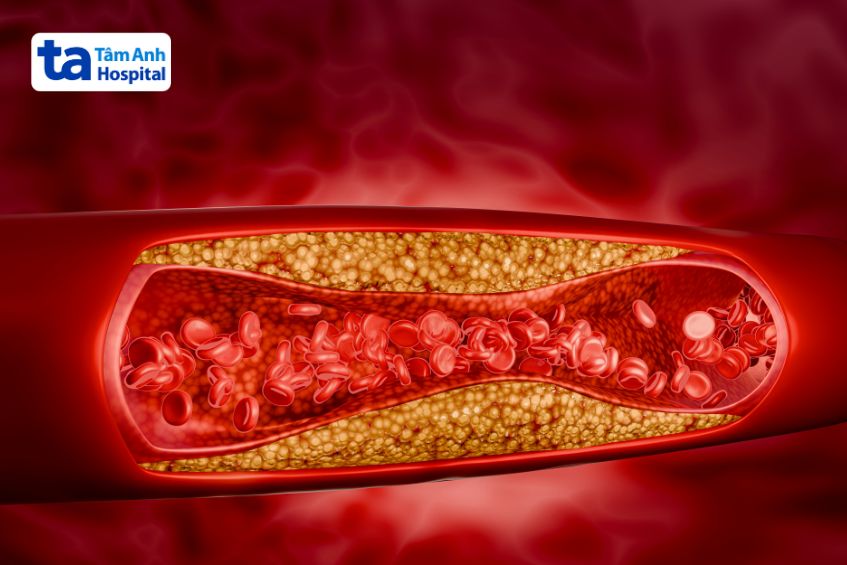 Cholesterol cao có thể tích tụ thành mảng bám, gây hẹp hoặc tắc nghẽn lòng mạch