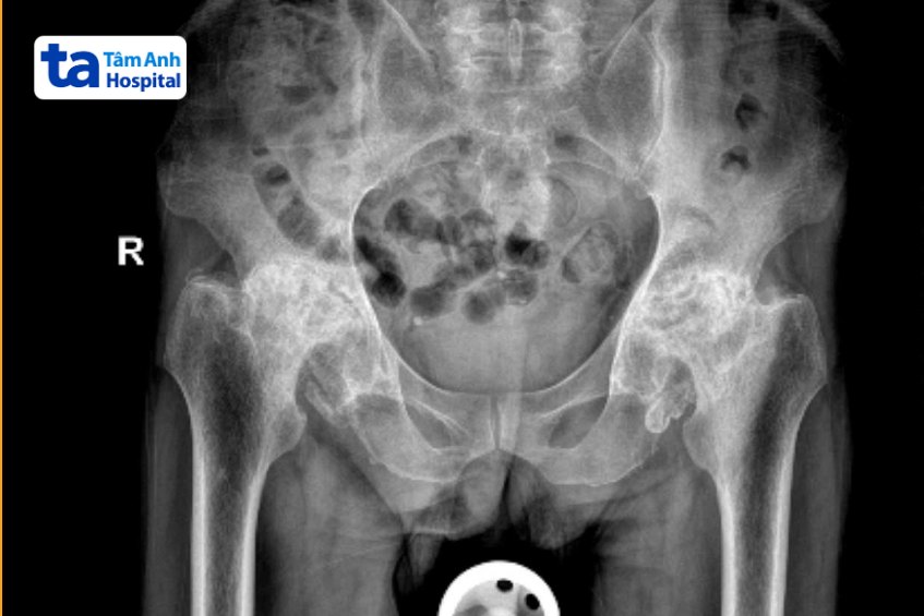 chụp x quang của ông nhựt