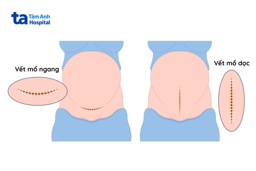 Có hai cách mổ lấy thai là vết mổ ngang hoặc vết mổ dọc, tùy vào từng trường hợp cụ thể mà bác sĩ sẽ có chỉ định cách mổ đảm bảo an toàn