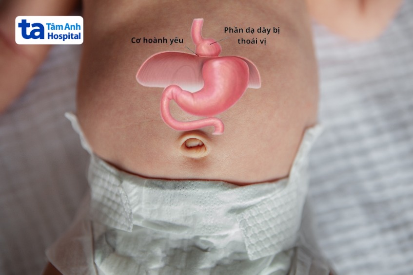 cơ hoành bị thoát vị sẽ phát triển không hoàn toàn