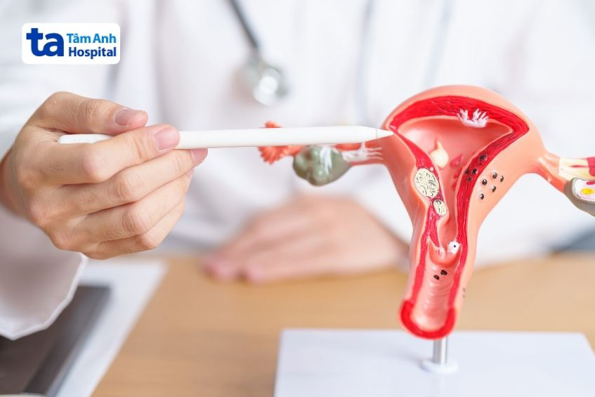 có thể được phát hiện sớm qua kiểm tra