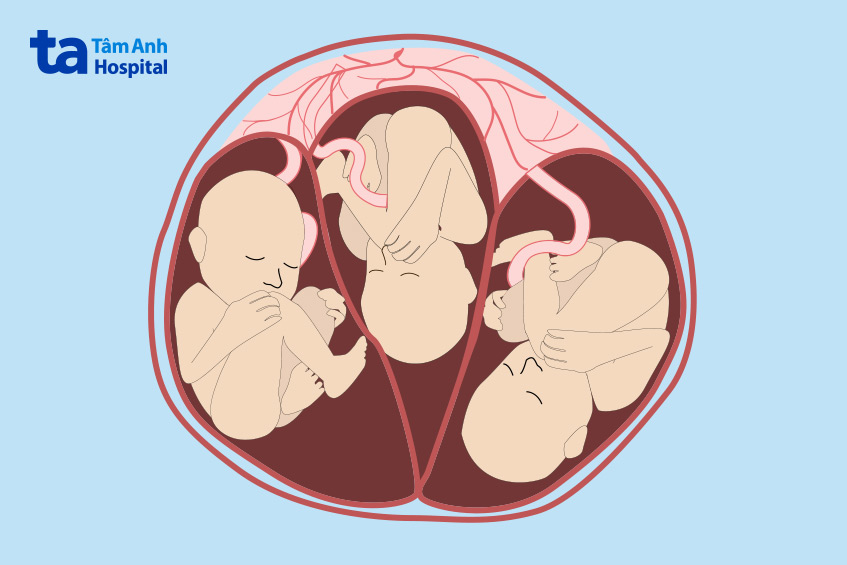 Đa thai IVF là mang thai từ hai thai nhi trở lên
