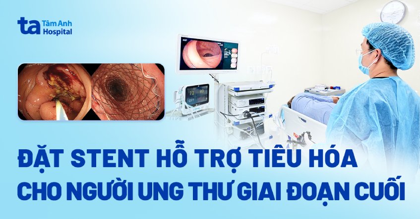 đặt stent hỗ trợ tiêu hóa
