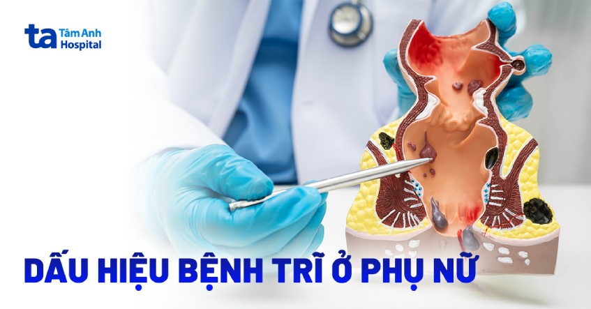 Dấu hiệu bệnh trĩ ở phụ nữ: Nguyên nhân, chẩn đoán và phòng ngừa