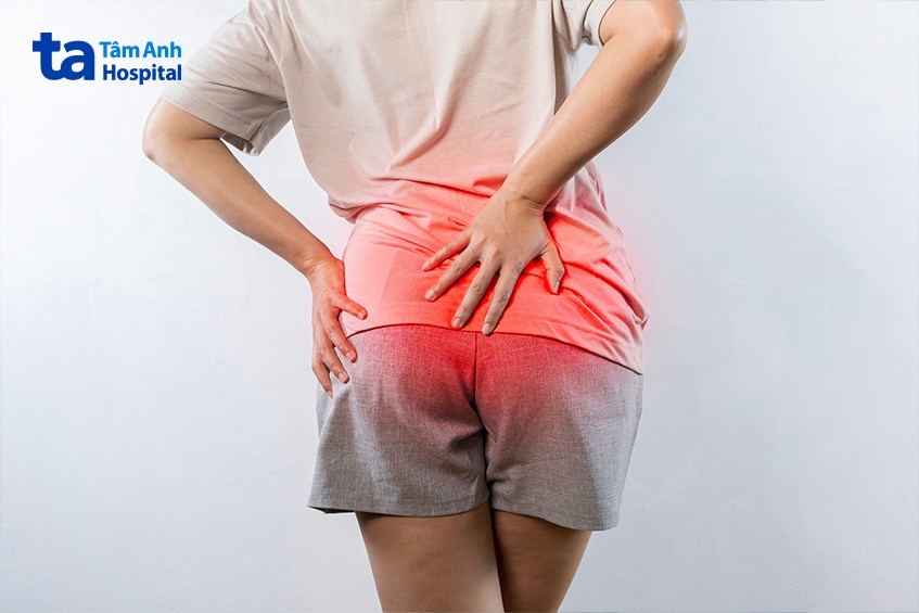 dấu hiệu của bệnh trĩ ở phụ nữ