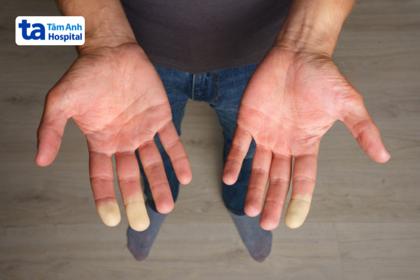 dấu hiệu của u nhầy với triệu chứng raynaud