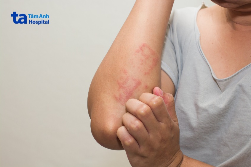 dấu hiệu viêm da cơ địa ở người lớn