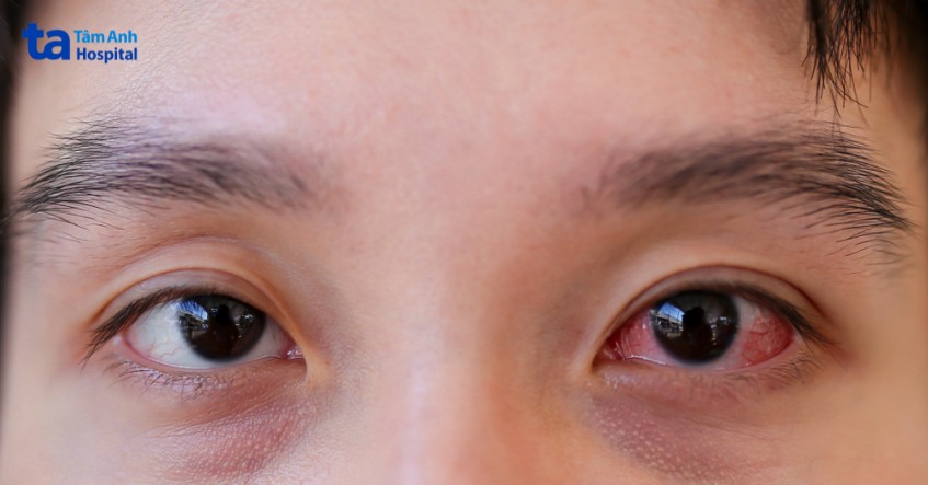 dễ nhầm giữa viêm và phù kết mạc