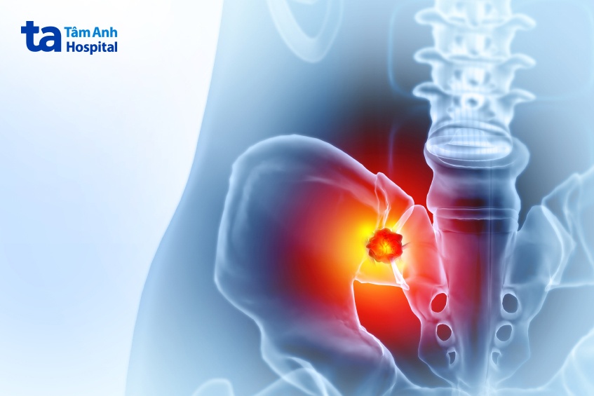 di căn xương chậu từ ung thư tuyến tiền liệt