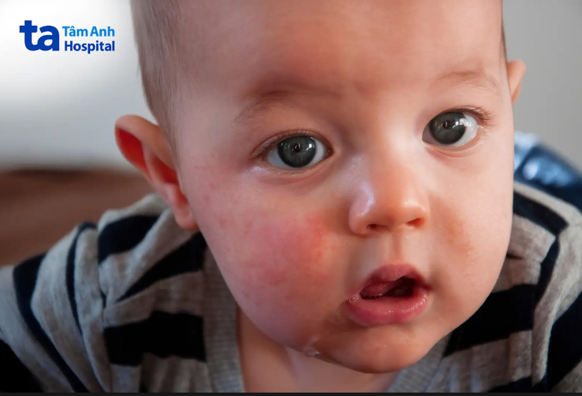 Dị ứng đạm bò có thể chẩn đoán được dựa vào các vấn đề trên da sau khi uống sữa