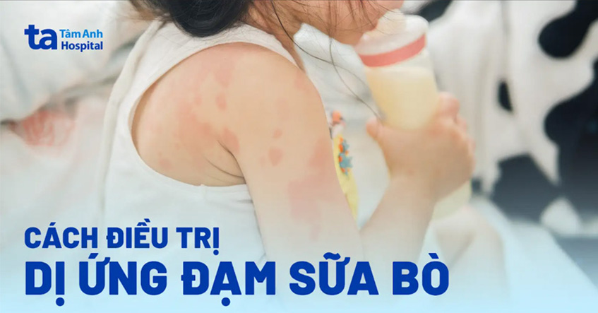 Dị ứng đạm sữa bò là gì? Nguyên nhân, tỷ lệ và cách điều trị