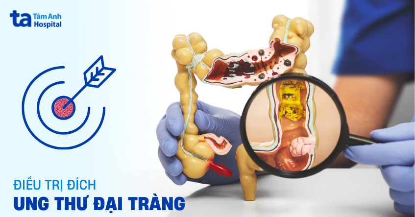 Điều trị đích trong ung thư đại tràng là gì? Có hiệu quả không?