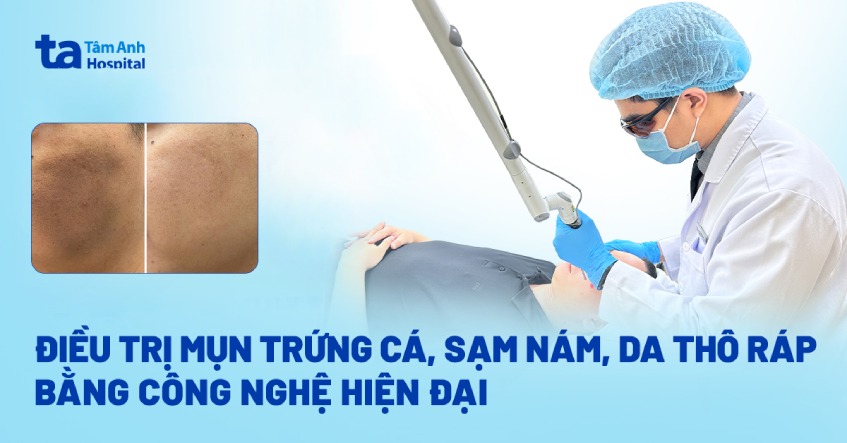 điều trị mụn sạm nám da thô ráp bằng công nghệ