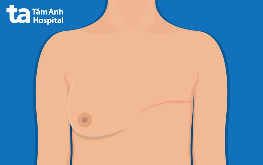 điều trị ung thư vú chủ yếu là cắt bỏ khối u