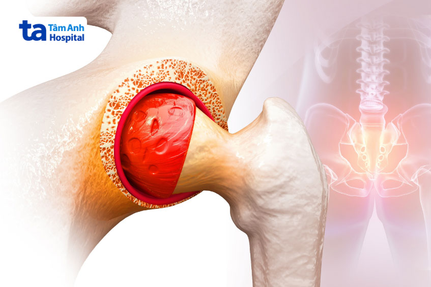 Điều trị viêm khớp háng phụ thuộc vào nguyên nhân