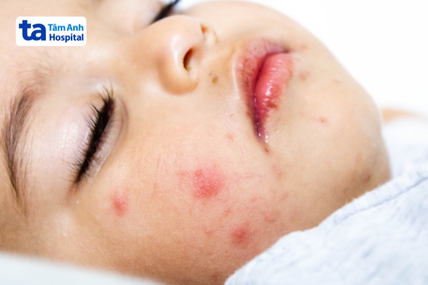 độ nghiêm trọng khi trẻ tái nhiễm bệnh tay chân miệng