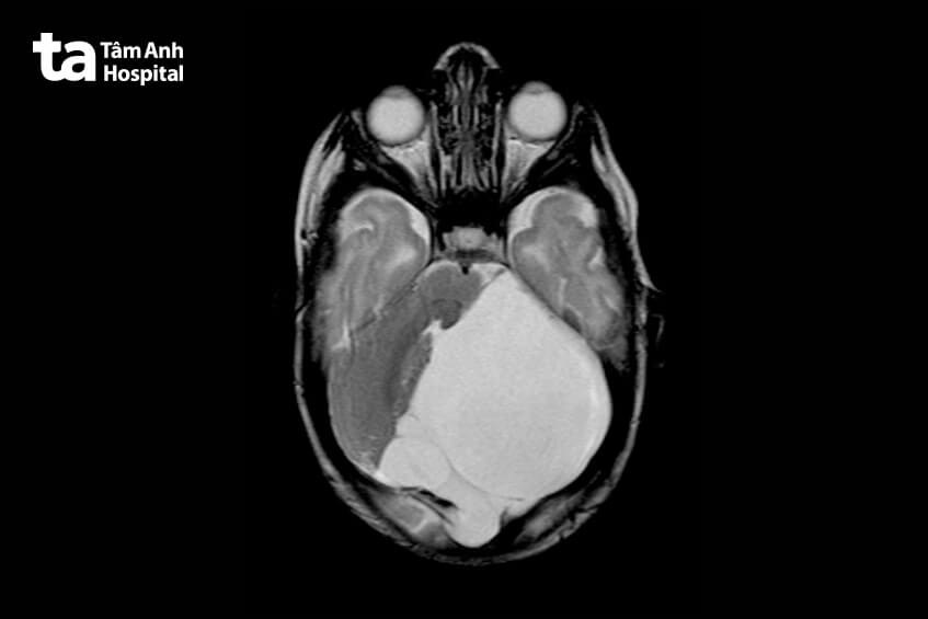 độ nguy hiểm của nang màng nhện