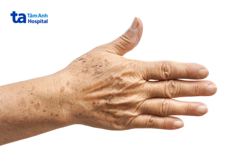 đồi mồi ở người già thường xuất hiện ở bàn tay