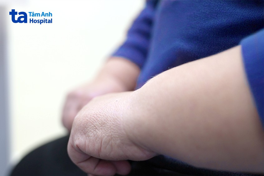 đôi tay bệnh nhân 131kg