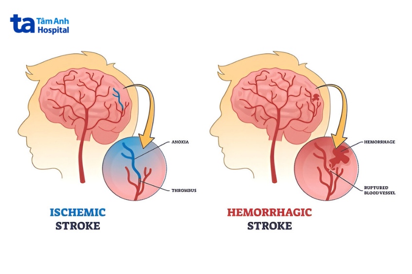 đột quỵ khi quan hệ có thể do tắc nghẽn hoặc xuất huyết