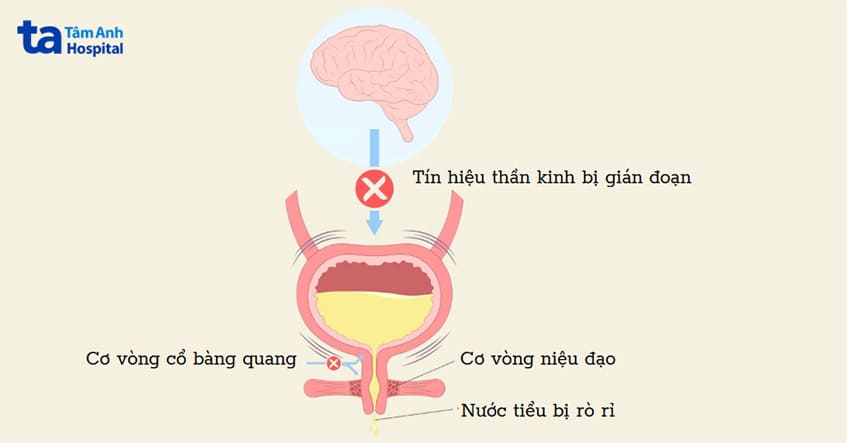đường truyền thần kinh từ não tới bàng quang bị gián đoạn