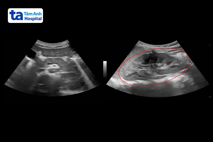gan bệnh nhân có dấu hiệu tổn thương
