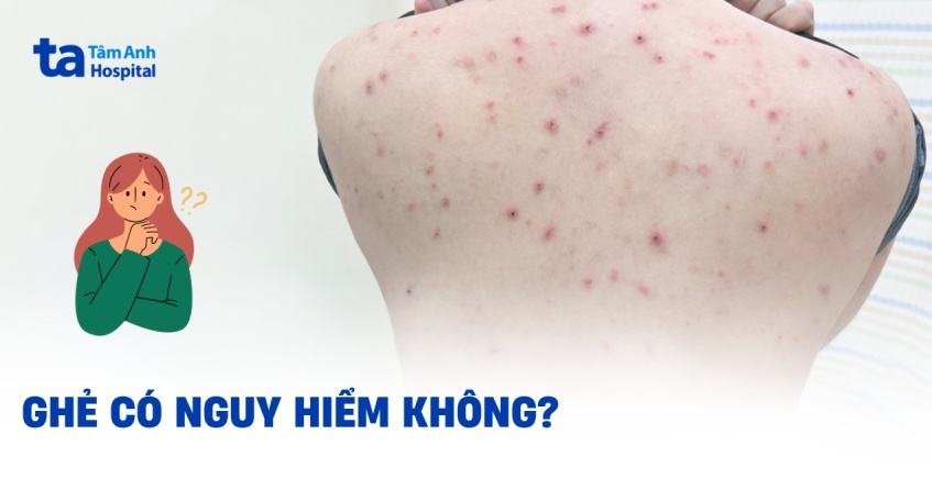Ghẻ có nguy hiểm không? Biến chứng khi không điều trị kịp thời