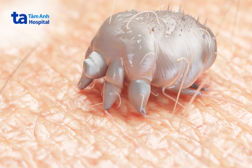 ghẻ nước là bệnh nhiễm ký sinh trùng ở da