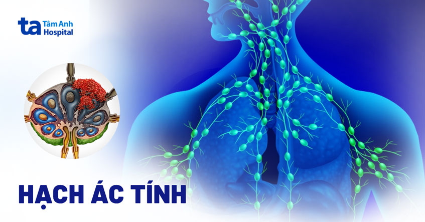 Hạch ác tính là gì? 6 dấu hiệu hạch ung thư điển hình