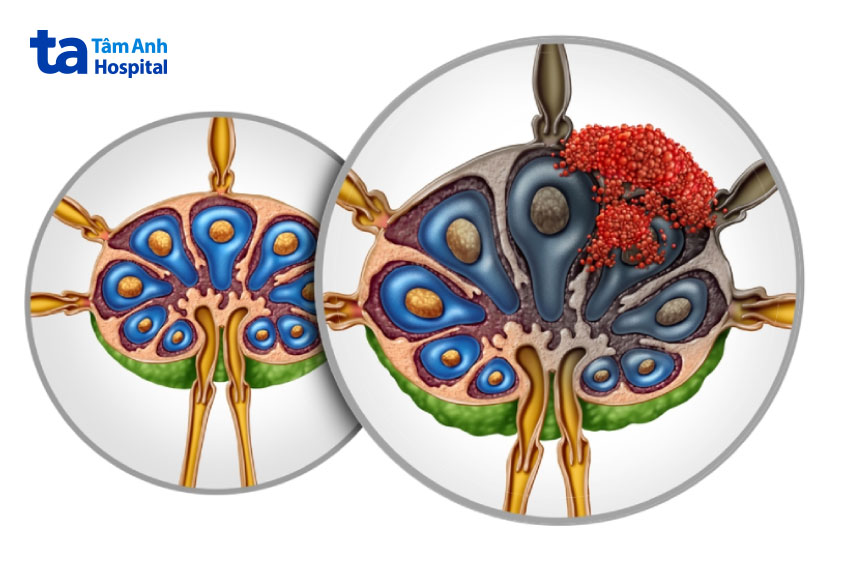 hạch bạch huyết chứa tế bào ung thư