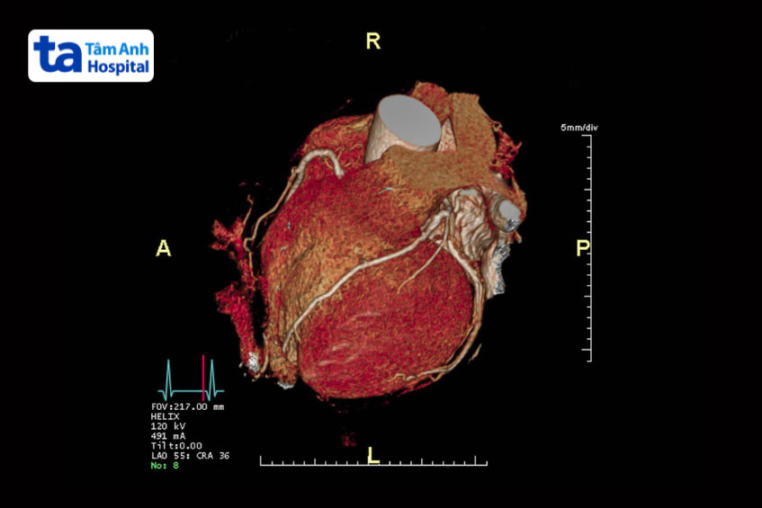 hình ảnh 3d chụp ct mạch vành