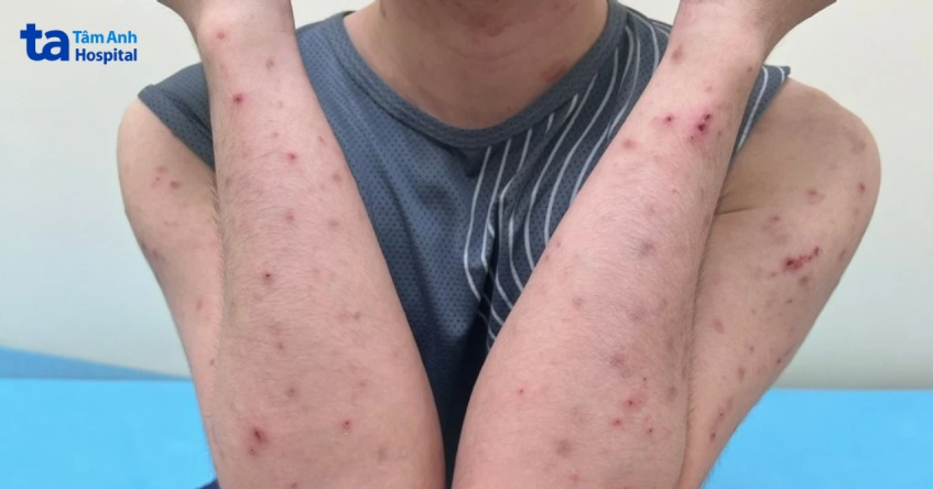 hình ảnh bệnh ghẻ trên cơ thể