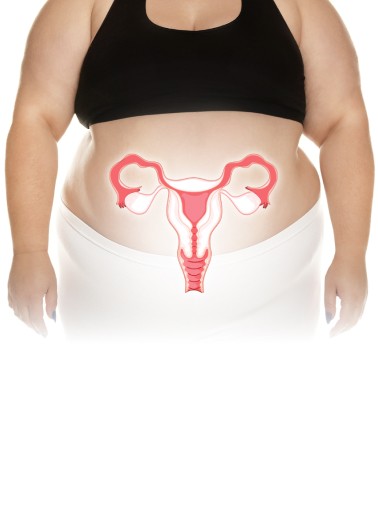 hình ảnh buồng trứng đa nang béo phì