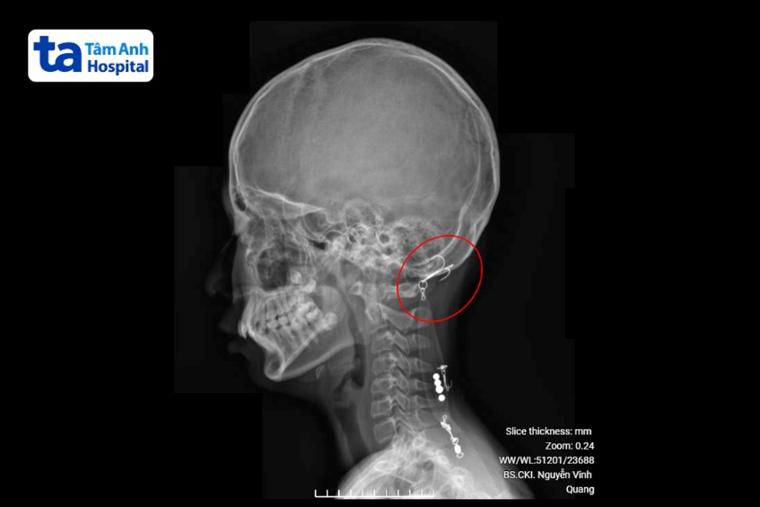 hình ảnh chụp x-quang cho thấy móc câu đâm vào đầu bệnh nhi
