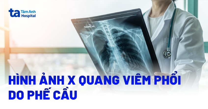 Hình ảnh chụp X quang viêm phổi do phế cầu chi tiết