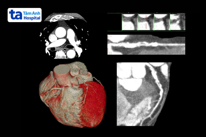 hình ảnh ct động mạch vành