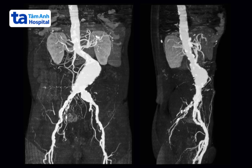 hình ảnh ct phình động mạch chủ bụng