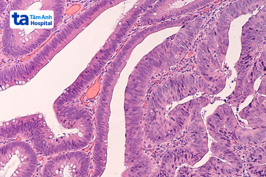 hình ảnh dị sản ruột dạ dày