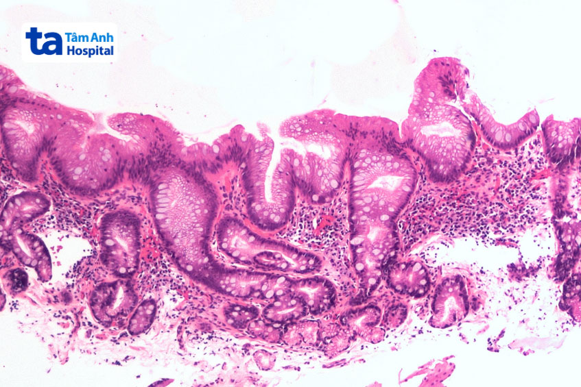 hình ảnh dị sản ruột