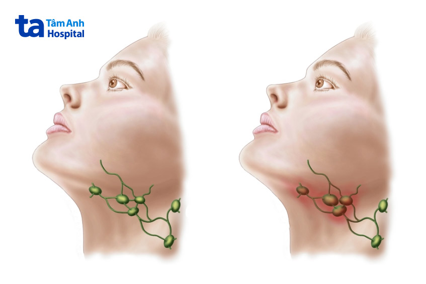 hình ảnh hạch bị viêm