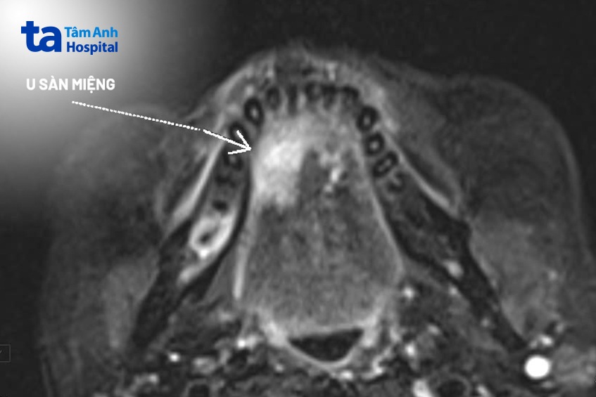 hình ảnh khối u sàn miệng