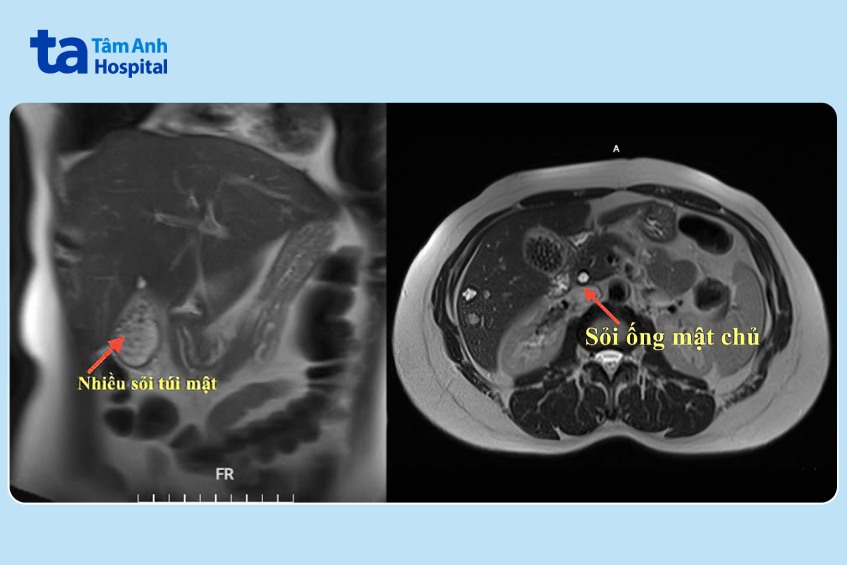 hình ảnh mri sỏi túi mật