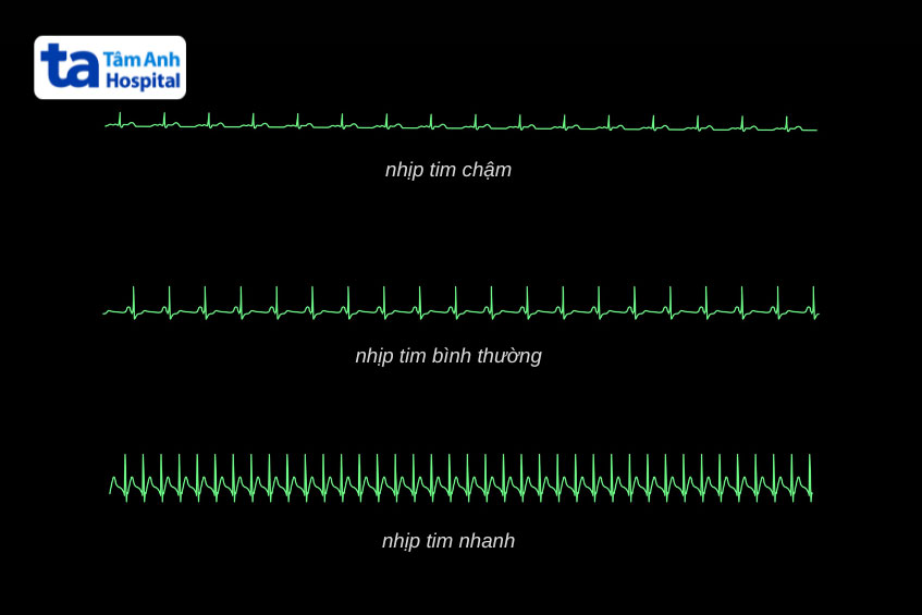 hình ảnh nhịp tim trên ecg