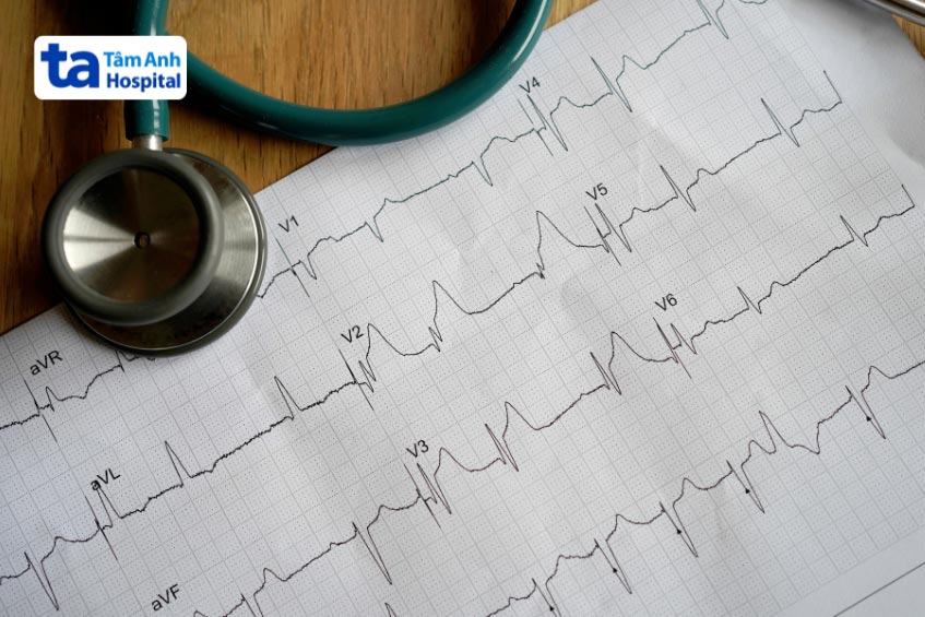 hình ảnh nhồi máu cơ tim stemi